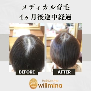 メディカル育毛でつむじの割れと目立つ分け目を改善☆