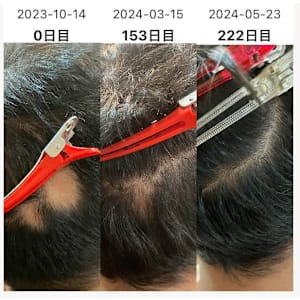 円形脱毛症の改善