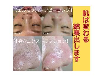 脱毛と毛穴ケア専門　La Coquette(福岡県福岡市中央区)