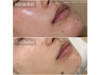 【肌質改善】Salon de BLANC クリスティーナ/ハーブピーリング/毛穴/小顔/痩身(東京都港区)