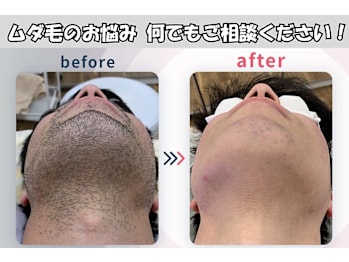 メンズ脱毛NEXT+梅田店(大阪府大阪市北区)