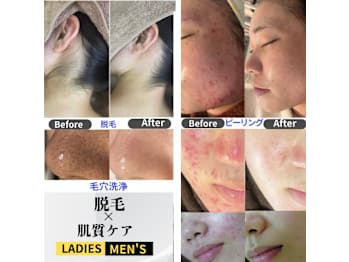 【ハーブピーリング|肌質改善】BE:SKIN広島(広島県広島市中区)
