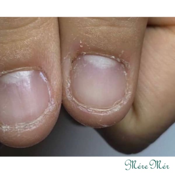 深爪緩和メニュー　ビフォー　3|深爪専門ネイルサロンMereMer petit 池袋店