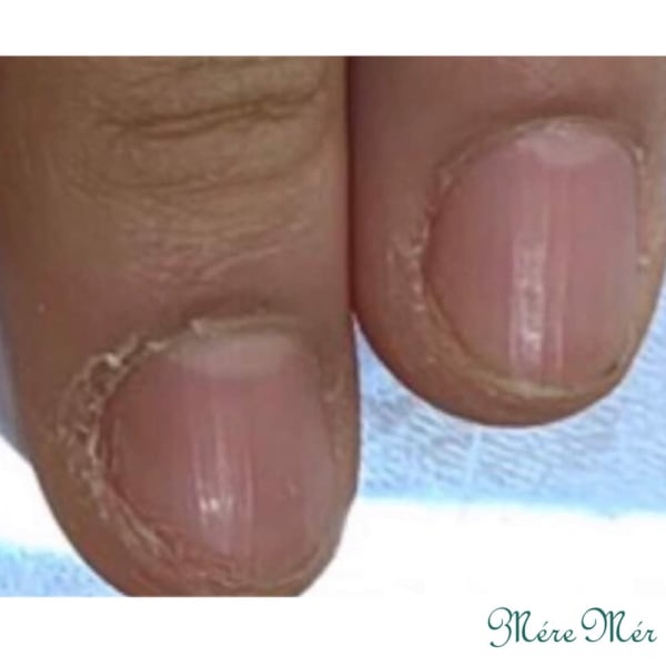 深爪緩和メニュー　ビフォー　5|深爪専門ネイルサロンMereMer petit 池袋店