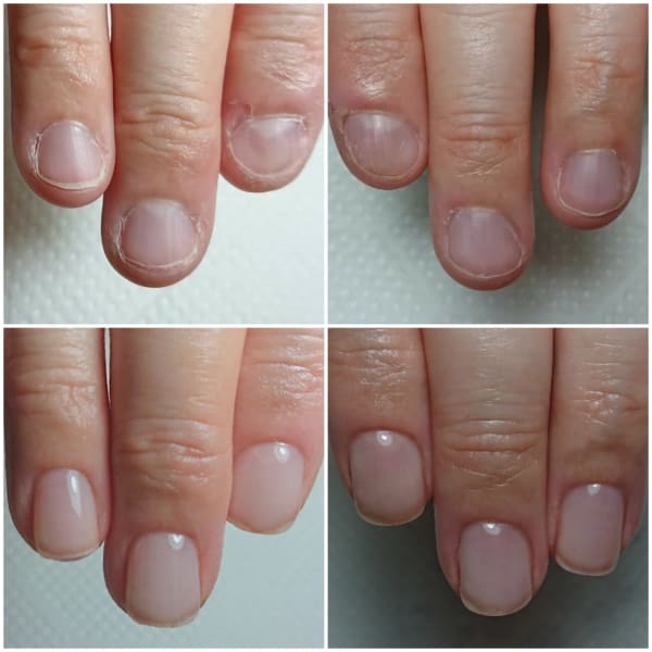 深爪ケアコース