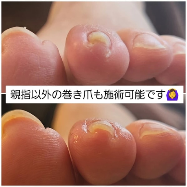 巻き爪コース|美爪育成ネイル&頭蓋骨小顔矯正サロン-Jeliss-