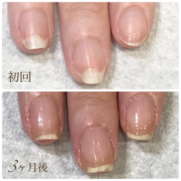 最強のネイルケア(自爪育成3ヶ月コース)の症例