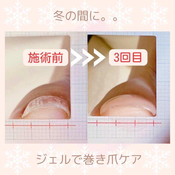 巻き爪ケア