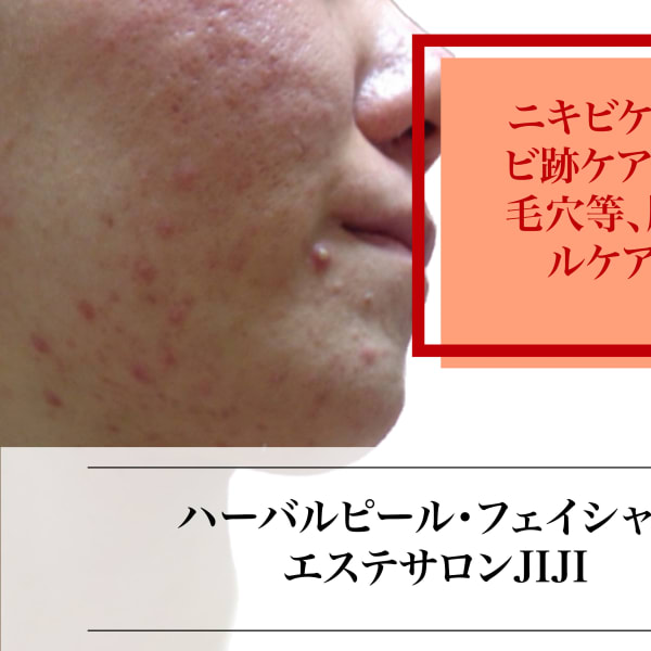 ハーバルピール・フェイシャル専門 エステサロンJIJI新宿