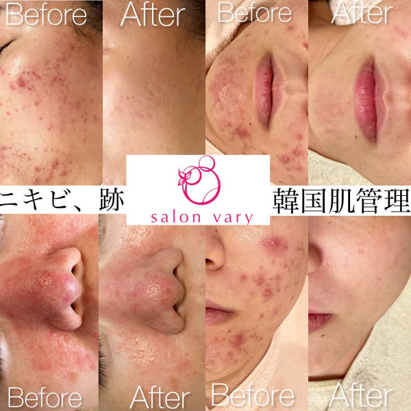 肌質改善水玉リフティング＆ハーブピーリングsalonvary