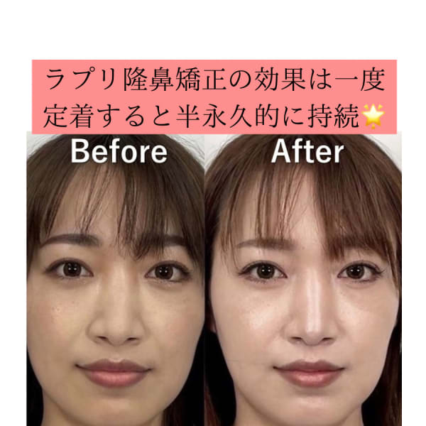 隆鼻矯正専門店 Raplit 広島八丁堀 美鼻・小顔矯正・毛穴洗浄(ラプリ)