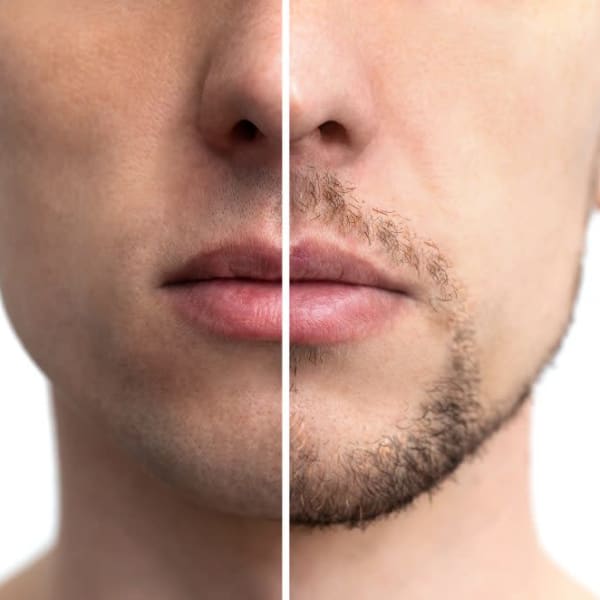 メンズ脱毛メンズビービー 福井高柳店