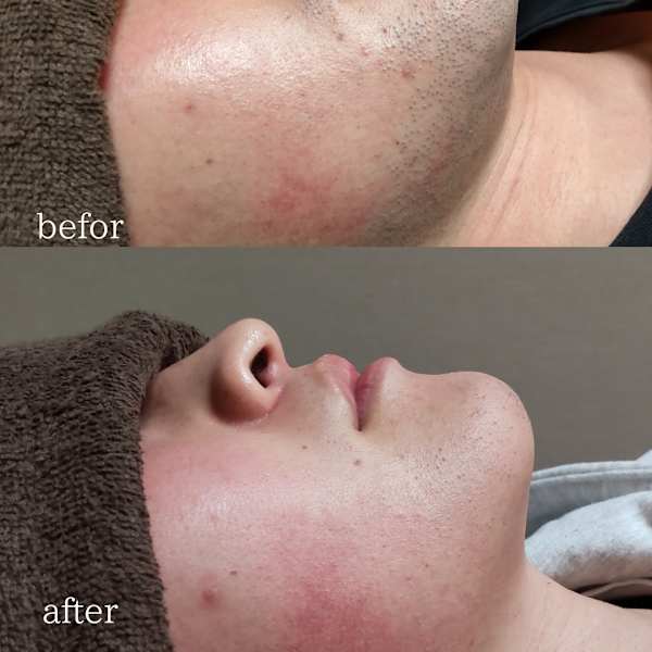 ヒゲ脱毛専門店 will