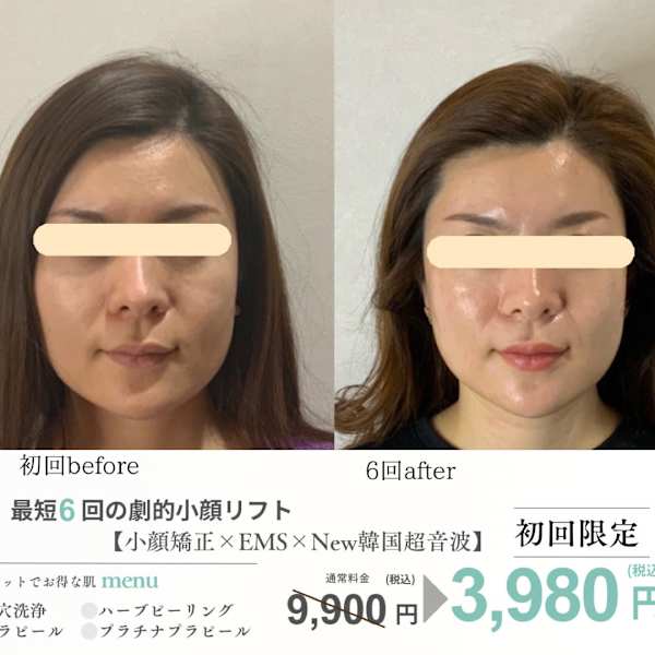 小顔・肌質改善サロンespoir ハーブピーリング/毛穴