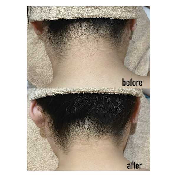 脱毛メニュー|M's Style NAIL BAR