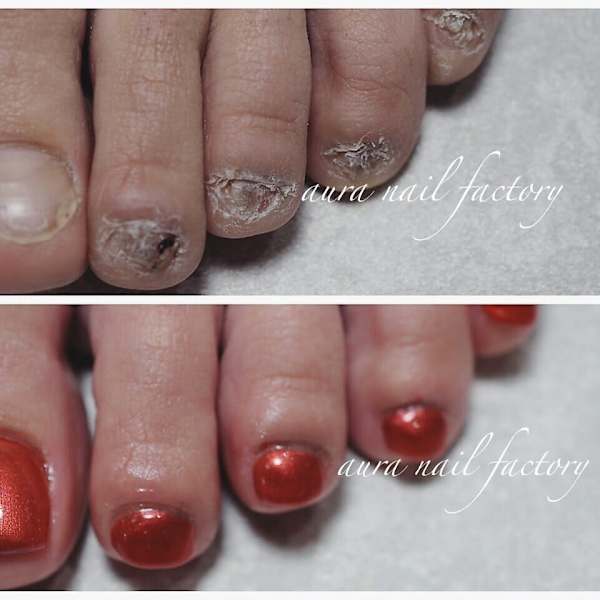 FOOT深爪矯正スカルプ(長さだし)フットネイル長さ出し☆