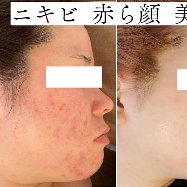 肌質改善サロンNoa