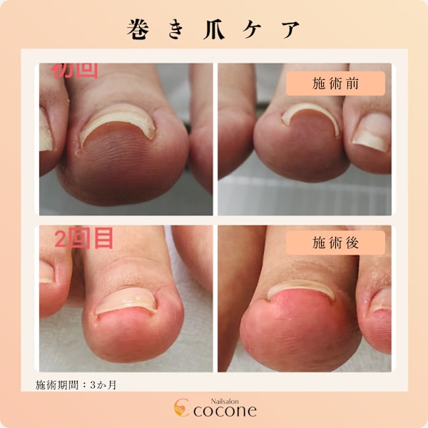 巻き爪ケア