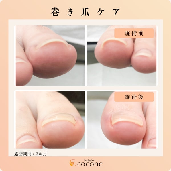 巻き爪ケア
