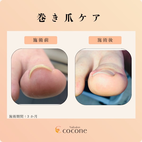 巻き爪ケア