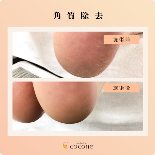 角質ケア