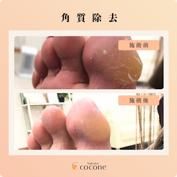 角質ケア