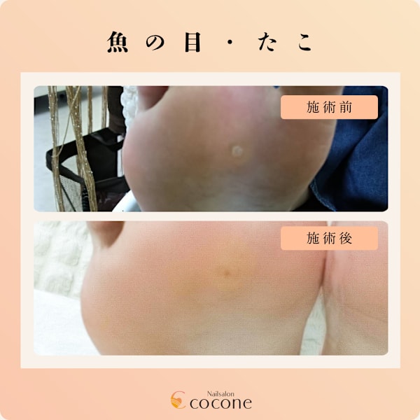 たこ・魚の目ケア