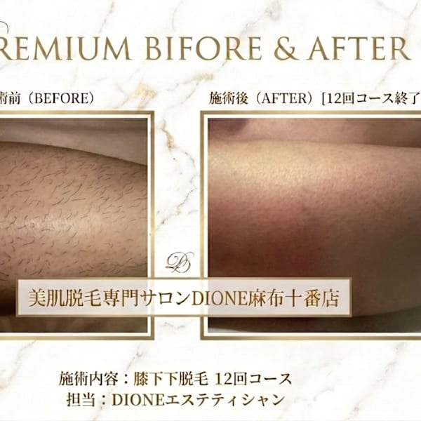 美肌脱毛専門サロン Dione 麻布十番店