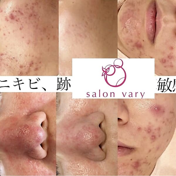 肌質改善水玉リフティング＆ハーブピーリングsalonvary
