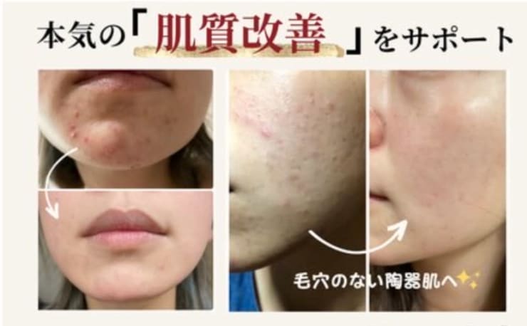 松ヤニパック コスメ・美容 バイオウォーミーパック