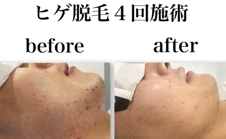 メンズ脱毛フェイシャル専門店 Joieange京橋 メンズダツモウフェイシャルセンモン ジョアアンジェキョウバシ の予約 サロン情報 エステサロンを予約するなら楽天ビューティ