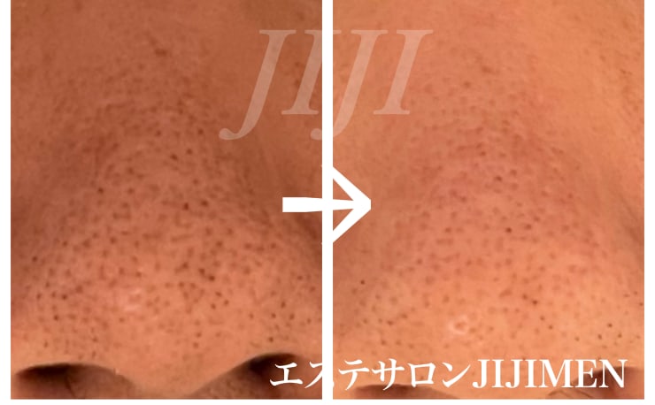 ハーバルピール　3点 ハーバルピール クレーター＆頬の赤み | ハーバルピールブログ