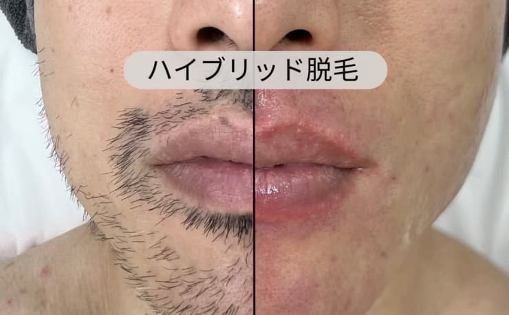 美肌脱毛専門店 Pearl plus 東岡山店【パールプラス】【小顔/痩身