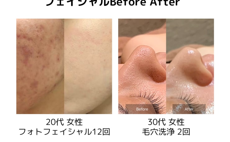 渋谷BELZE【脱毛・毛穴洗浄・フェムケア・ローマピンク】(シブヤ