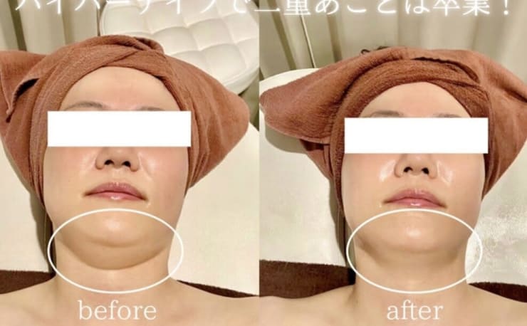 ハイパーナイフ小顔×痩身専門エステCLORE浦和店(ハイパーナイフコガオ 
