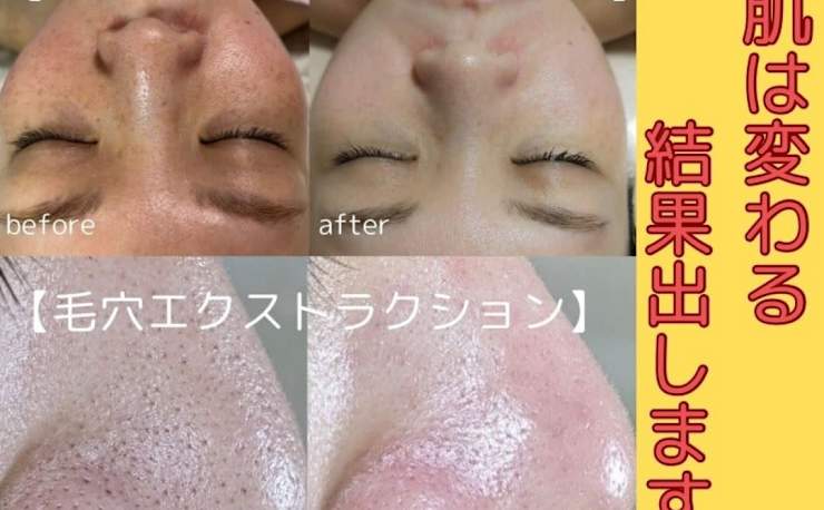 最終値下げ！アデランス 肌の美容　ピーリング fractional CC 【公式】フラクショナルCC ニードルピーリングジェル