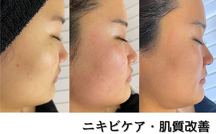 肌質改善】全身ハーブピーリング専門店 Lapeca~ラペカ~名古屋