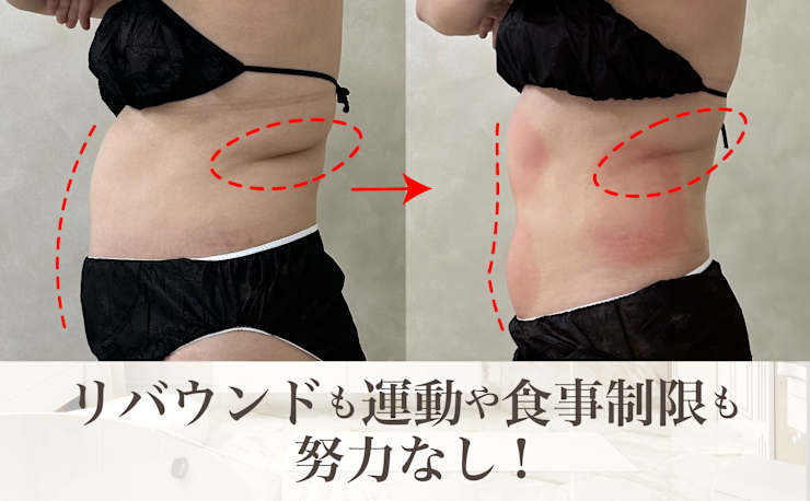 【送料込】脂肪冷却マシン痩身 エステ 脂肪冷却/痩身専門サロン We Beaute(シボウレイキャク ソウシン