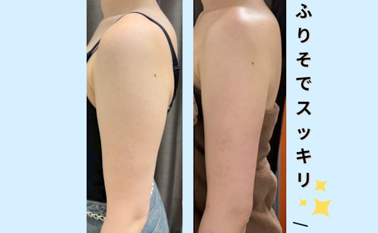 脂肪冷却　4ハンドルセット 脂肪冷却専門店 Total Studio B-Revolution 秋葉原 上野店(シボウレイ