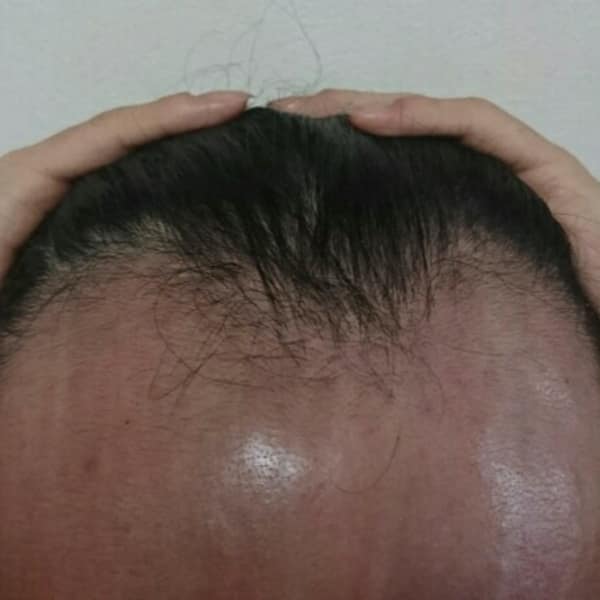 ホントに生えるコース ビフォー