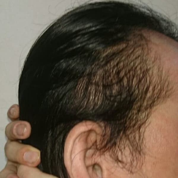 ホントに生えるコース ビフォー