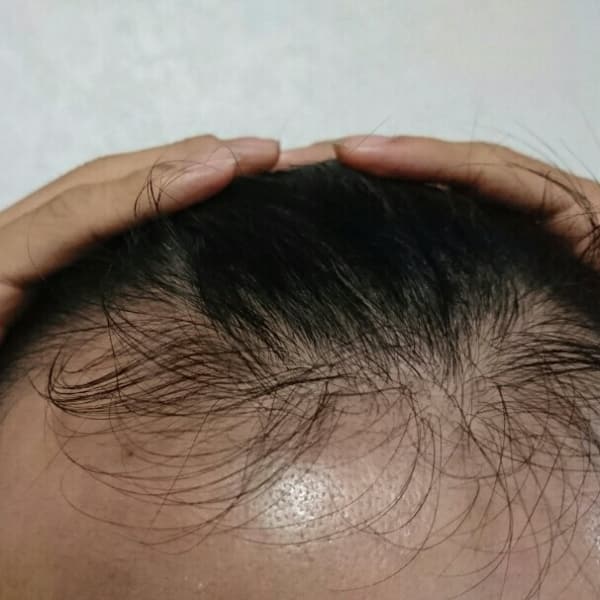 ホントに生えるコース アフター