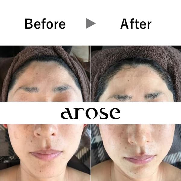 光フェイシャル