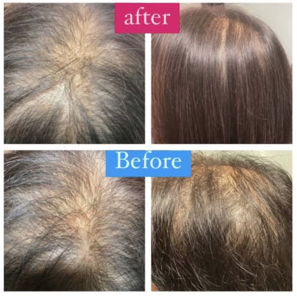 本格発毛育毛コース