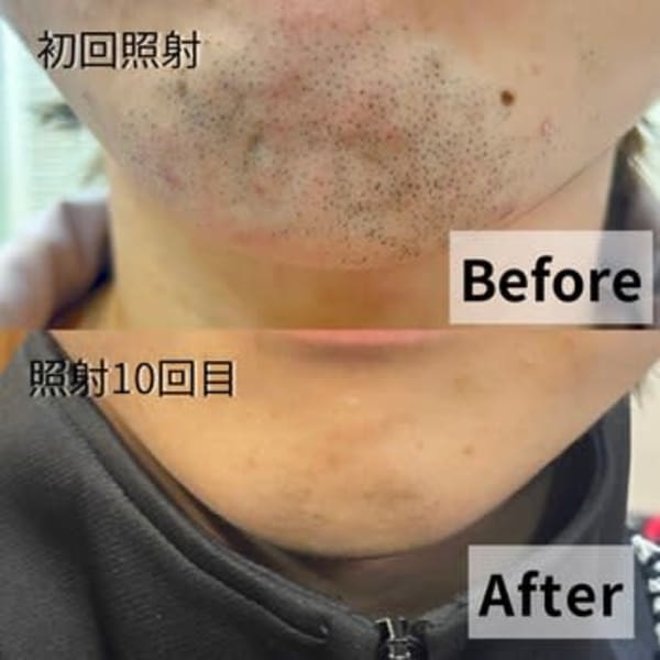 ひげ脱毛|ALICe by AFLOAT