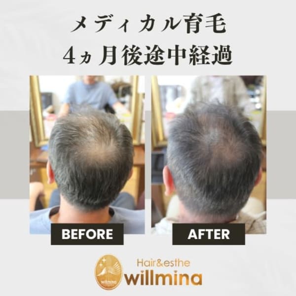 松本で当店のみのオリジナル施術◎メディカル育毛|くせ毛専門美容室ヘアエステ ウィルミナ