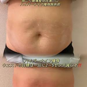 ハイパーナイフ専用クリームは脂肪細胞のダイエット効果と