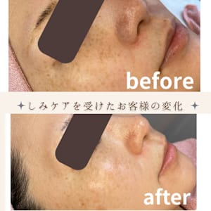 3in1シミケアエステ 3in1シミケアエステ