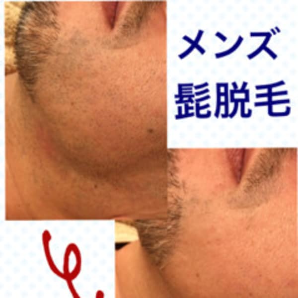 メンズ髭脱毛|STELLA