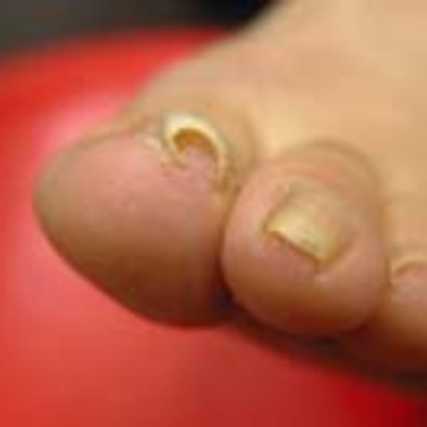 お得に巻き爪矯正♪両親指やるとカラーリングもついてくるキャンペーン実施中！|ネイルスペース 蒲田